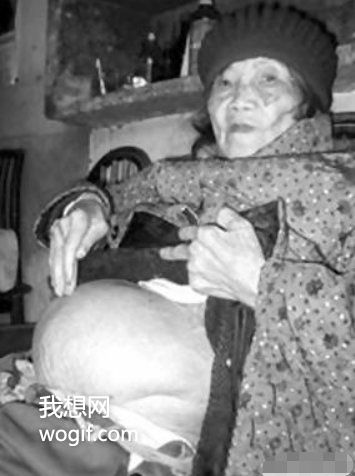 四川一91歲老奶奶不慎摔倒,到醫院后發現懷孕了(60年前懷上的)