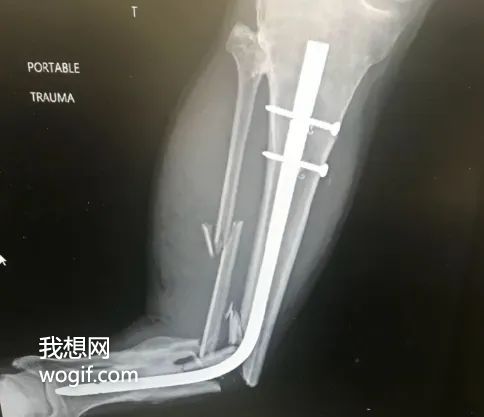 康復(fù)期間，再次車禍，體內(nèi)鋼管彎了（圖）